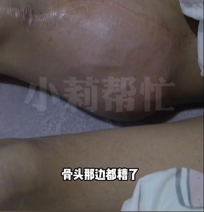 男孩患肿瘤依旧选择将14万救命钱充进不朽情缘电子游戏因玩游戏会忘记疼痛(图3)
